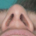 bottom post rhinoplasty