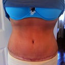 scar 4 weeks PO  still a few small scabs but almost ready for the silicone strip!