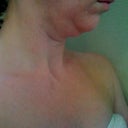 day before surgery