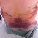 Day 5 PO. My flank/lower back bruising (from lipo) is changing colors - seeing more green/yellow on flank area and more black/blue on lower back area.