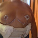 day of surgery