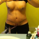 Day 4 Post Op