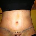 Day 4 Post OP