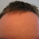 Today, 1 month post. Scars diminished and better complexiton. Probably still some micro-swelling improving the look