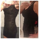 Left: Before surgery and flat, flat, flat. Right: 16 weeks post op with a pooch in the same dress. The pointy protrusion is the ridge of my scar