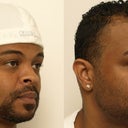 African American Rhinoplasty