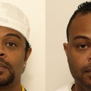 African American Rhinoplasty