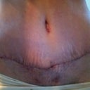 tummy scar - 2 weeks post op - pre scar therapy