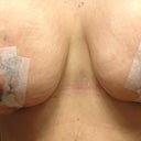 17 days PO, a bit lumpy, but I have to be patient....