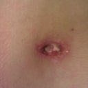 P.O. Day 18 - Belly Button Close Up