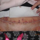 2 days post op