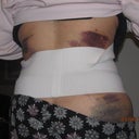 2 days post op
