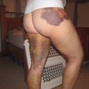 8 days post op