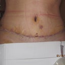 8 days post op