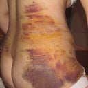 8days post op