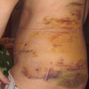 8 days post op