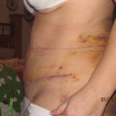 8 days post op