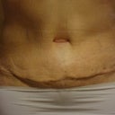 Here's the navel.  Too wide and not natural-looking.  The PS here is going to see if he can do anything about it in September, after the edema in the pubic area has gone down.