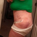 Po day 3 side view shows the biggest difference!