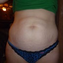 Tummy- front view 6 days pre op