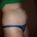 Tummy- side view 6 days pre op