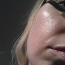 1 week after 1st treatment