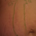 Stretch mark length