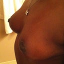 post op 21 days left side view
