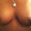 post op 21 days frontal view