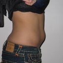 3 weeks post zeltiq