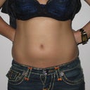 3 weeks post zeltiq