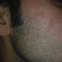 Fraxel But without the spot