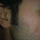 Fraxel But without the spot