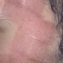 Left side after fraxel. look to the brown place deep burn