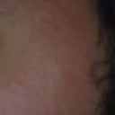 Left side 10 days after fraxel very bad redness and not heal places