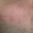Spot befor fraxel my face