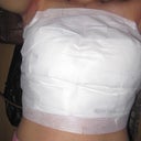 All bandaged up, bleeding coming from right nipple yesterday, today there is more fluid leaking around towards the side of the right boob