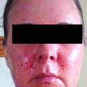 Day of procedure/hours after.