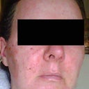 Day 1 - first day after procedure