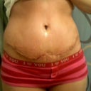 1 week post op incision