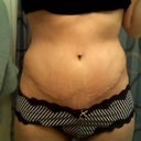 2 weeks post op incision