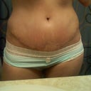 3 weeks post op incision