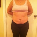 Front view.  Day before surgery.