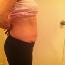 Side view.  Day before surgery