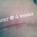 scar is low and super thin..healing well so far!