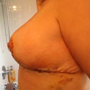 left side 5 days post op