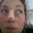 home resting 2 hrs later. you can see the beginning of my bruising