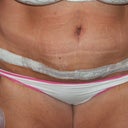 2 days post op
