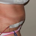 2 days post op, I'm hoping some of this is swollen.