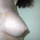 Side view of the breast that was sunken in